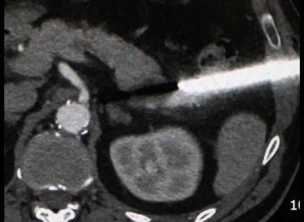 Anche sedi apparentemente inaccessibili come in questo caso di neoformazione della coda pancreatica, possono essere bioptizzate in sicurezza utilizzando la guida TAC.